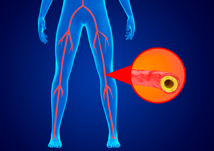 Peripheral Artery Disease Dr. Karl Zhang treating peripheral artery disease with minimally invasive angioplasty in New York City