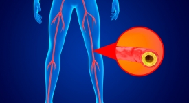 Peripheral Artery Disease Dr. Karl Zhang treating peripheral artery disease with minimally invasive angioplasty in New York City